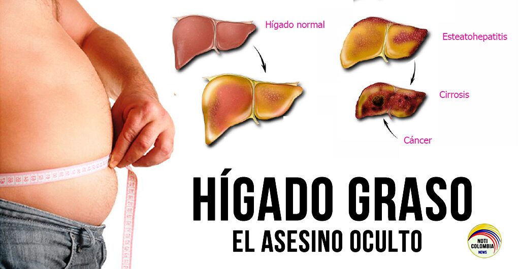 Hígado graso